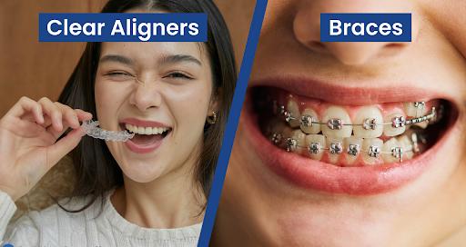 Dental braces alignment treatment at Family Dental Clinic Ravet Pune
