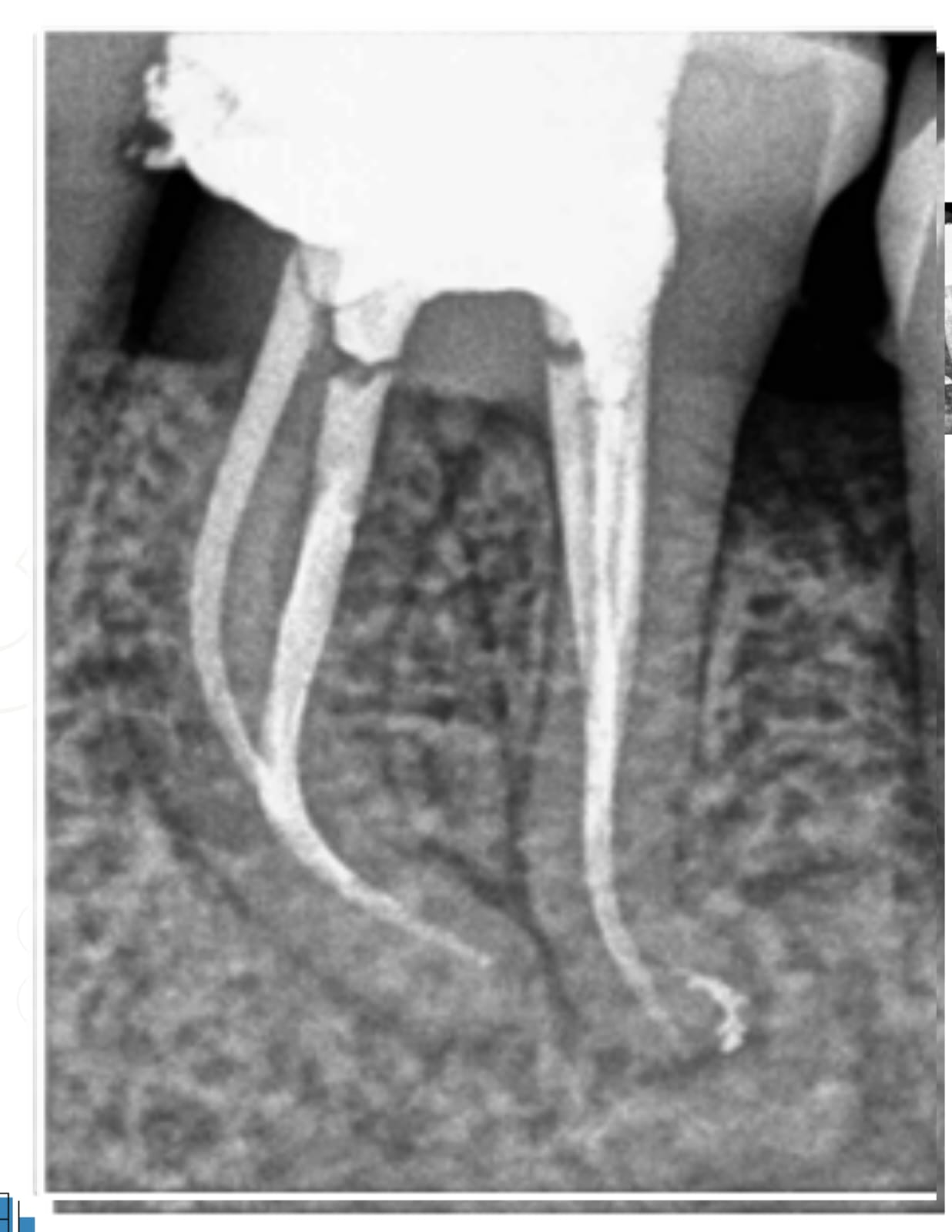 Painless root canal treatment at Family Dental Clinic Ravet Kiwale